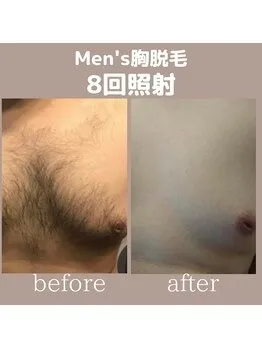 Men’s 胸脱毛